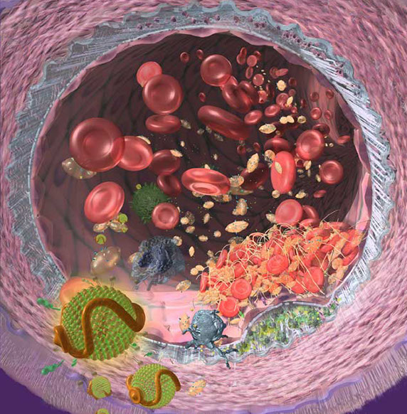 3D model depicting athereoscerosis, a complex array of foam cells, calcification, and lipid accumulation.