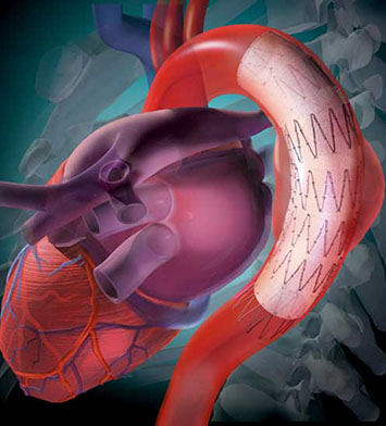Endovascular Graft for treatment of a thoracic aortic aneurysm Linda Nye Visualizing Nature