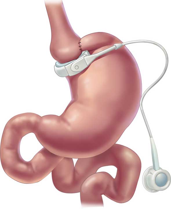 Surgical weightloss lapband proceedure. 