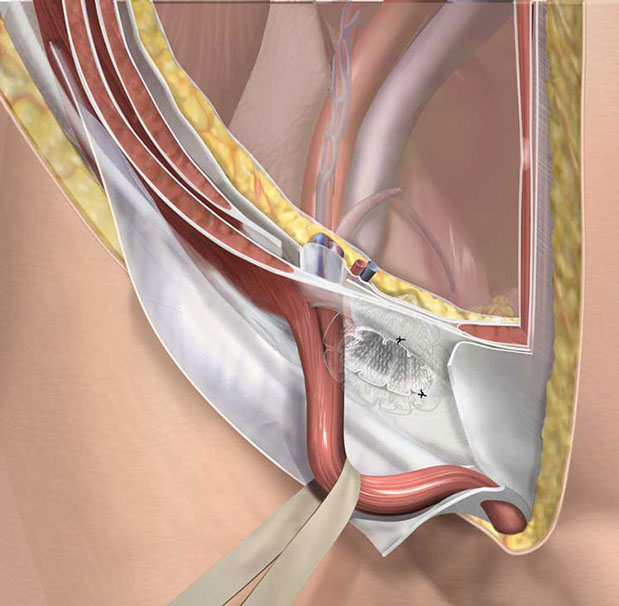 Surgical Technique guide for repair of a direct Inguinal Hernia. Linda Nye Visualizing Nature